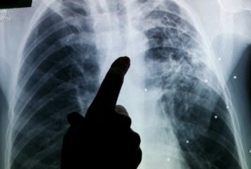 Akciğer Tüberkülozu (Verem)