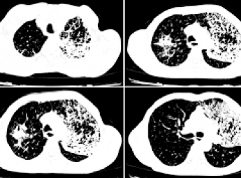 Akciğer Fibrozisi (Diffüz İnterstisiyel Akciğer Hastalığı, İPF) Nedir?